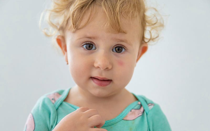 Alergia a insetos: Tudo o que precisa de saber
